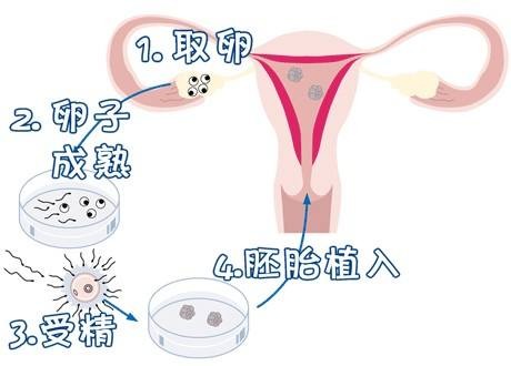 无精症案例